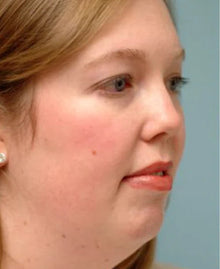 Before - Problema: Papada