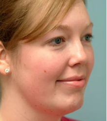 After - Problema: Papada