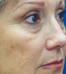 Before - Problema: Arrugas