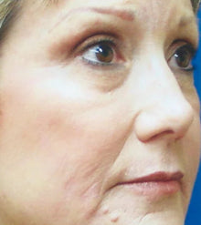 After - Problema: Arrugas