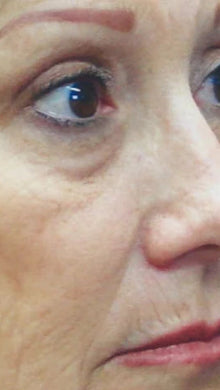 Before - Problema: Arrugas