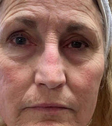 Before - Problema: Arrugas