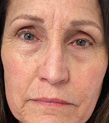 After - Problema: Arrugas