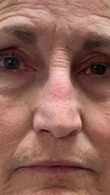 Before - Problema: Arrugas