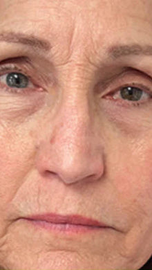 After - Problema: Arrugas