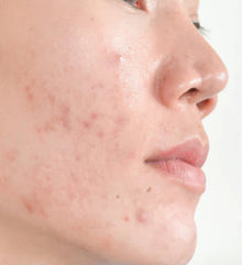 Before - Problema: Acné