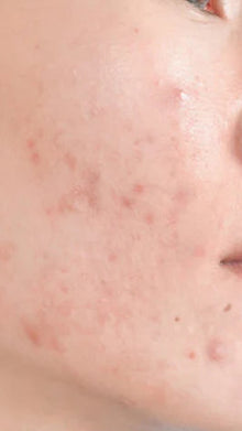 Before - Problema: Acné