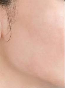 After - Problema: Acné