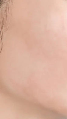 After - Problema: Acné