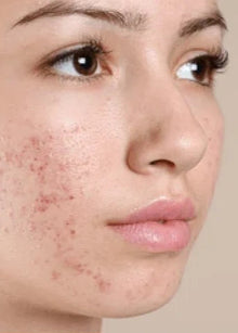 Before - Problema: Acné