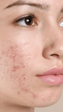 Before - Problema: Acné