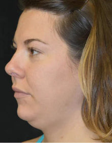 Before - Problema: Papada