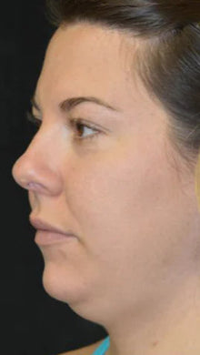 Before - Problema: Papada