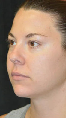 After - Problema: Papada