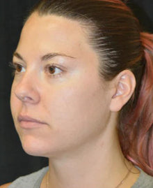 After - Problema: Papada