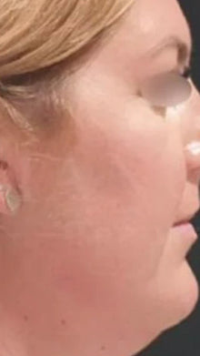 Before - Problema: Papada