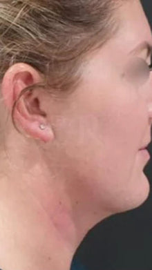 After - Problema: Papada